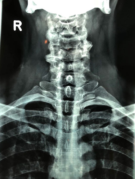 頸椎關節錯位及頸椎骨刺
