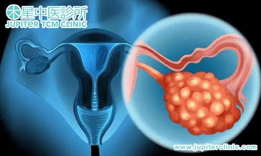 卵巢癌復發率近八成 木星中醫推薦腫瘤患者以中藥輔助治療渡癌關