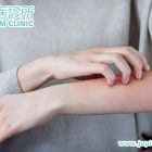 濕疹一直不好怎麼辦？香港九龍木星中醫診所建議內外兼用中藥加針灸