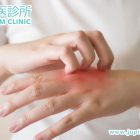 香港九龍木星中醫診所教你幾個日常KO濕疹的好方法