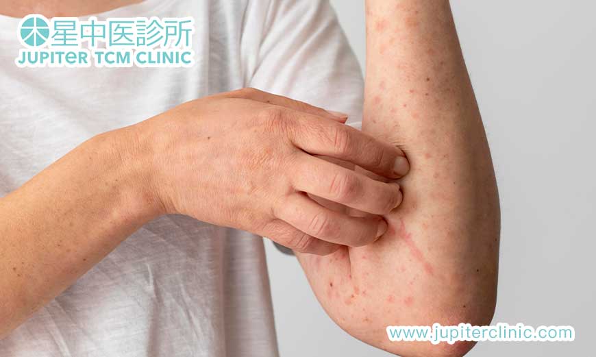 特發性血小板減少性紫癜調理：中醫「補氣攝血」針灸 + 中藥