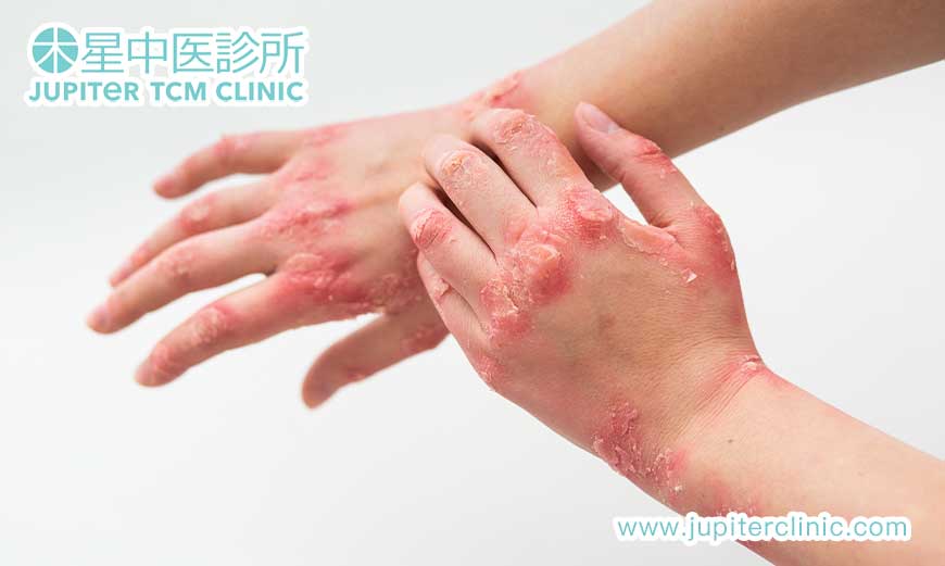 冬季凍瘡反覆？中醫「溫經散寒」穴位敷貼 + 中藥泡腳