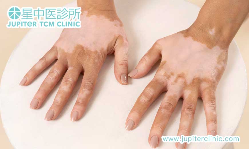 白癜風「膚色不均」調理！中醫「補腎活血」針灸，調節免疫，促進黑色素再生，重拾膚色勻稱！