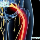 【電擊般痠麻】坐骨神經痛點算好？中醫小針刀微創療法，助您擺脫「由腰落腳」的痛苦！