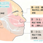臉部像被電擊、刀割一樣劇痛？中醫針灸助您告別「天下第一痛」——三叉神經痛！