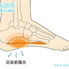 晨起「落地痛」？中醫教您對付足底筋膜炎，腳底不再硬掘掘！