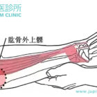網球肘（網球手）不再是運動員專利！辦公室OL、新手爸媽都中招？由木星中醫為您「治標又治本」！