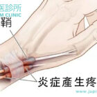 擊退「媽媽手」與「鍵盤手」！中醫如何精準治療腕部狹窄性肌腱鞘炎？