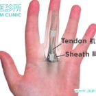 告別手指「卡住」的困擾！中醫如何精準治療「彈弓指」（板機指）？