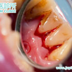 告別牙齦流血、牙齒鬆動！香港木星中醫：從根源治癒牙周病，守護您的「長壽之本」