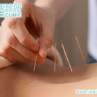 告別十年頑固痛症!「圓針治療」,讓您重獲無痛人生!