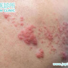 「皮蛇」纏身、神經痛如電擊？中醫治帶狀皰疹後遺症，為您根除頑固疼痛！