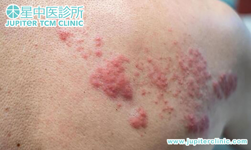 「皮蛇」纏身、神經痛如電擊？中醫治帶狀皰疹後遺症，為您根除頑固疼痛！